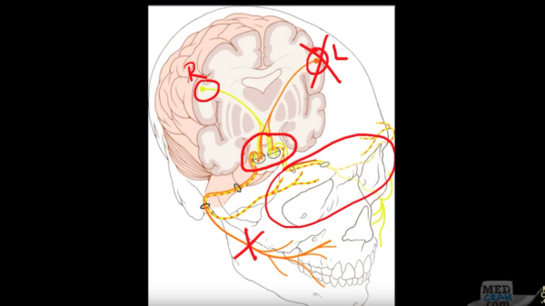 Bell's Palsy Explanation