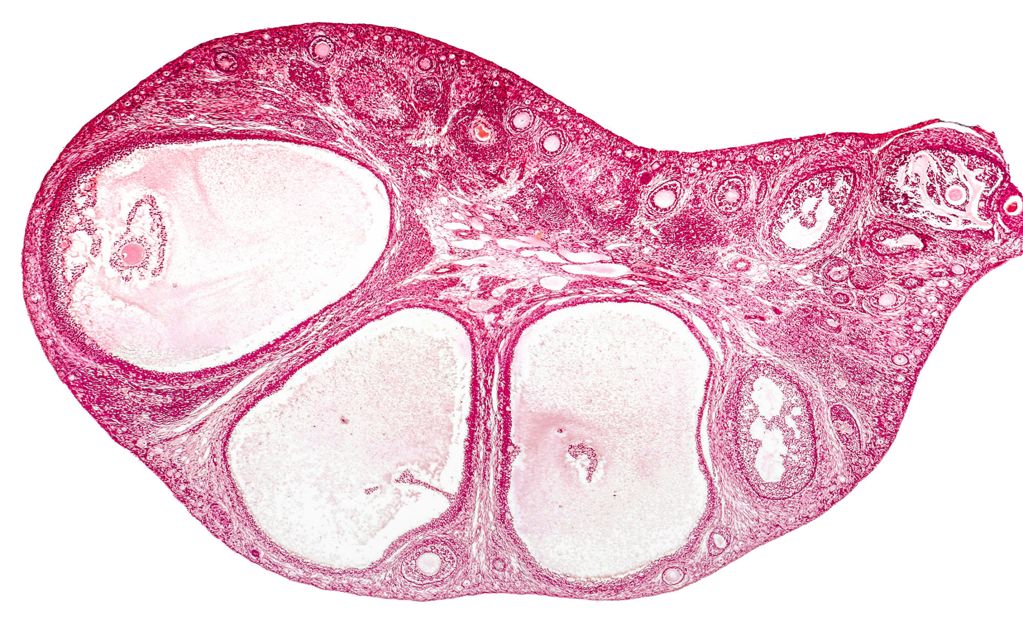 ovarian-torsion-board-review-question-video-explanation