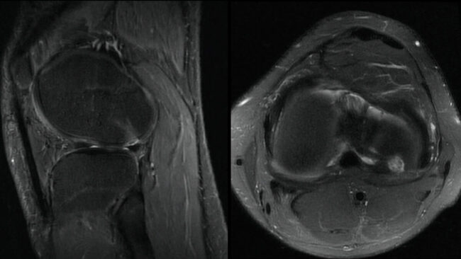 MRI of a football player sports medicine question