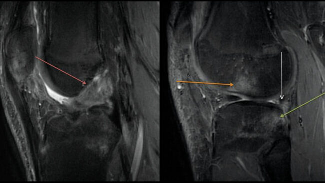 MRI of a football player sports medicine question