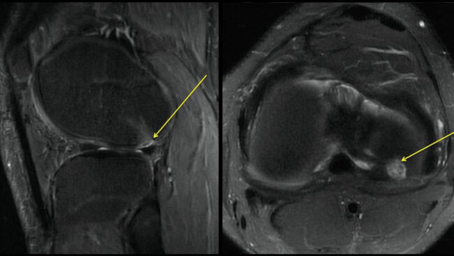 MRI of a football player sports medicine question