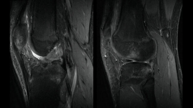 MRI of a football player sports medicine question